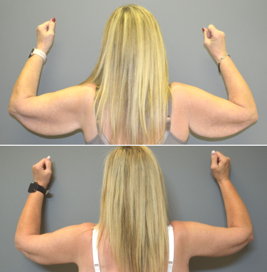 Before and After Image: Brachioplasty - back