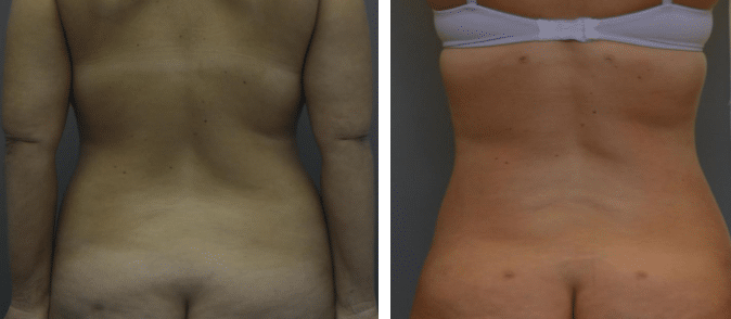 Before and After Image: Liposuction - back