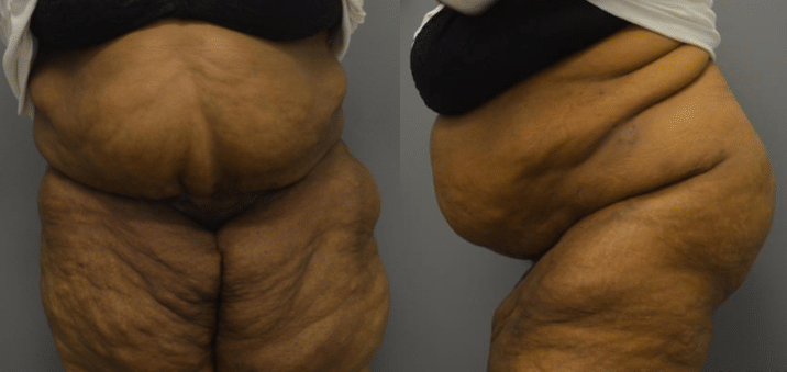 Before and After Image: Panniculectomy - front
