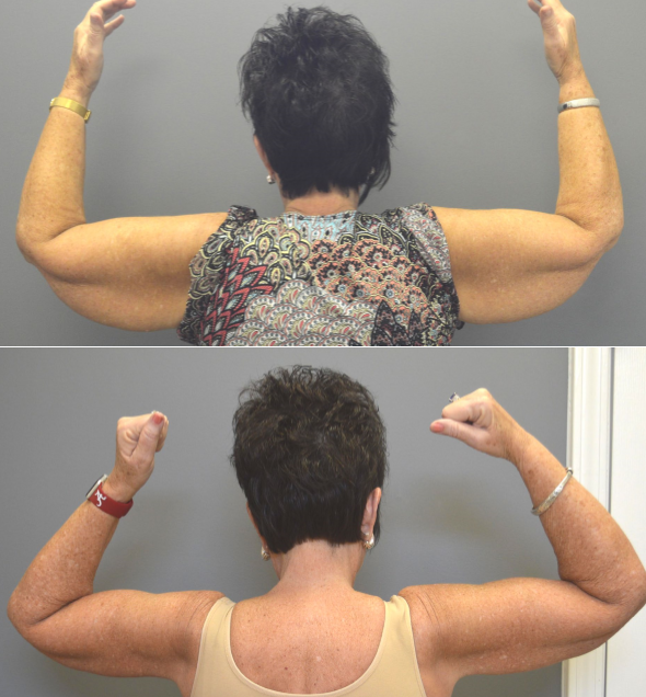 Before and After Image: Brachioplasty - back