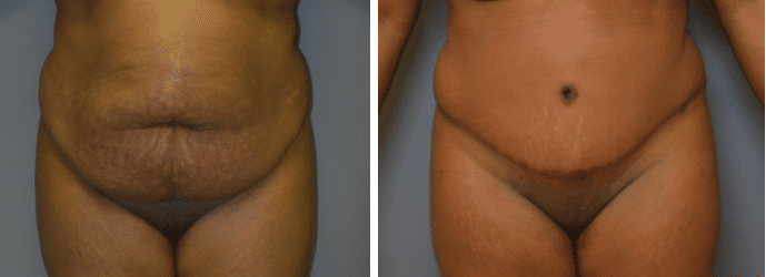 Before and After Image: Abdominoplasty - front