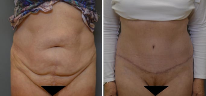 Before and After Image: Abdominoplasty - front