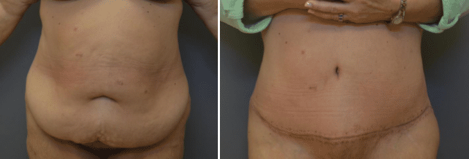 Before and After Image: Abdominoplasty - front