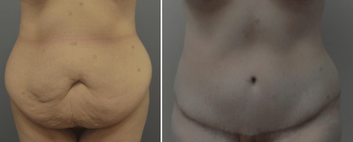 Before and After Image: Abdominoplasty - front
