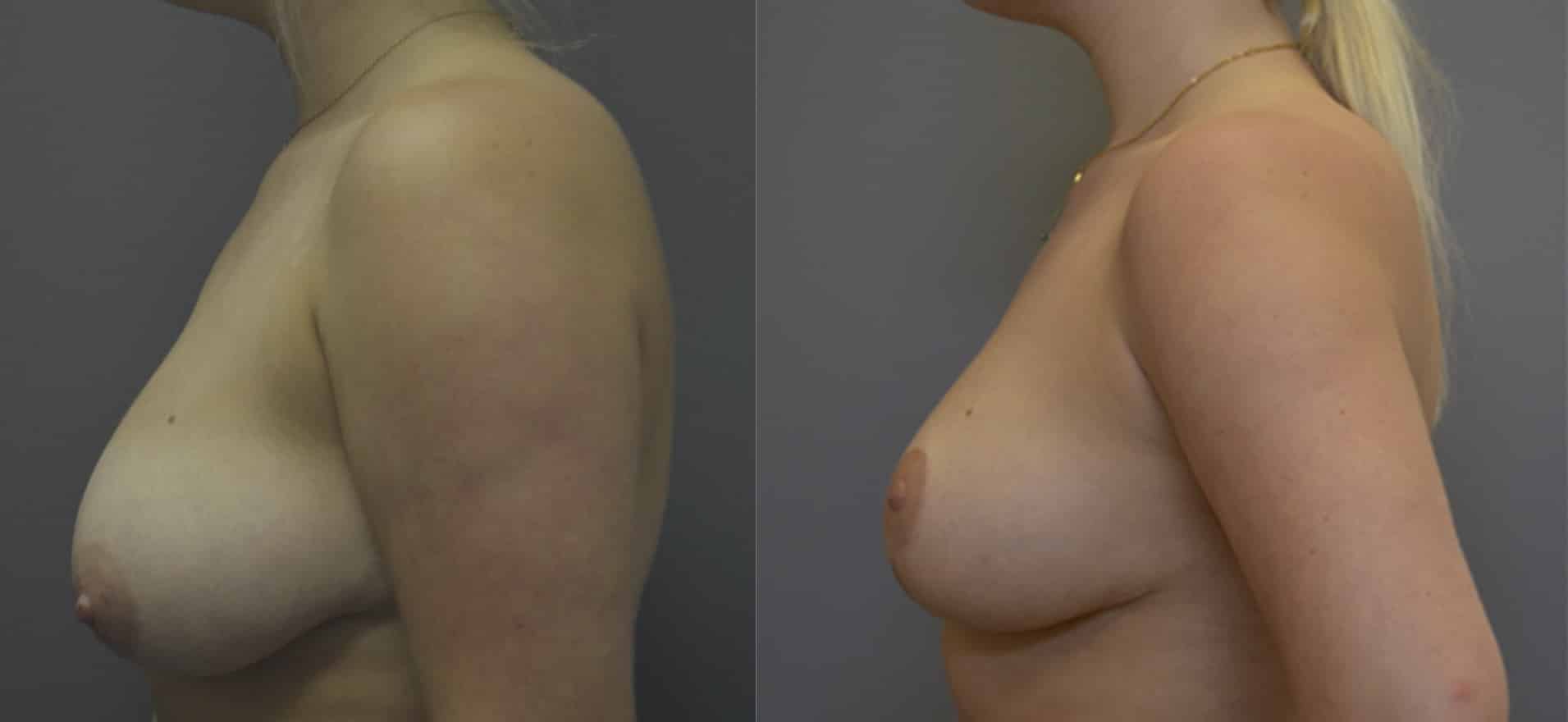 Before and After Image: Mastopexy & Liposuction - left-side