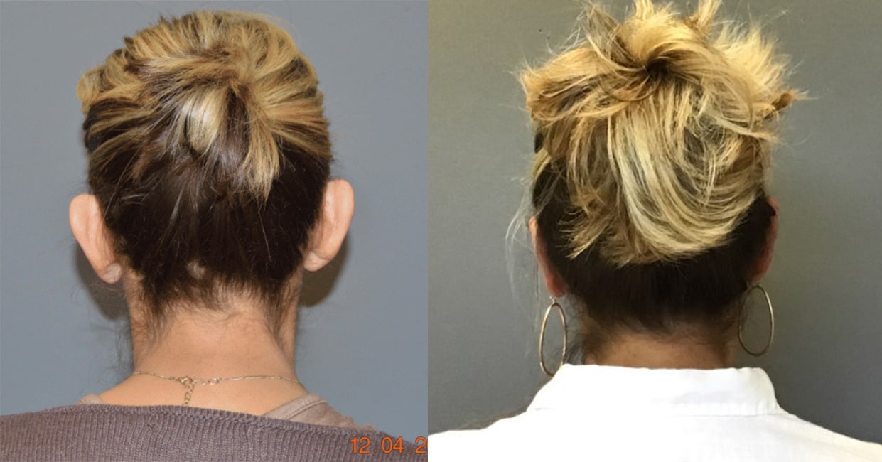 Before and After Image: Otoplasty - back