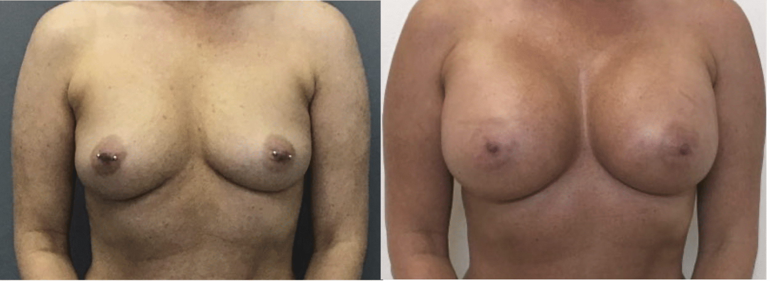 Before and After Image: Breast Augmentation - front