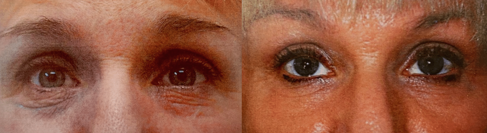 Before and After Image: Periorbital Chemical Peel - front