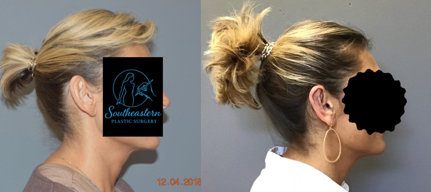 Before and After Image: Otoplasty - right-side