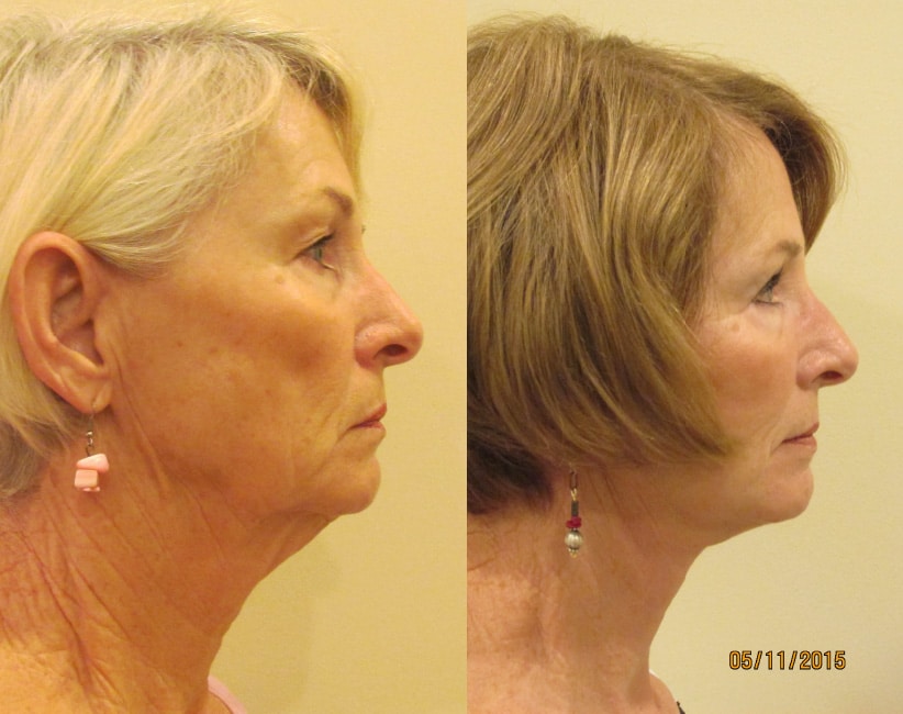Before and After Image: Facelift - right-side