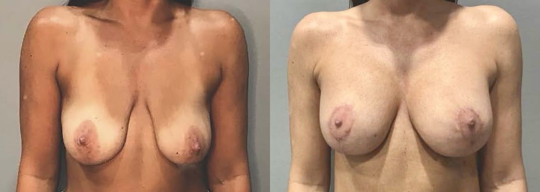 Before and After Image: Mastopexy augmentation with 350cc saline implants 6 weeks post op - front