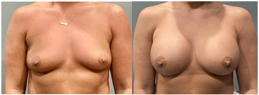 Before and After Image: Breast Augmentation - front