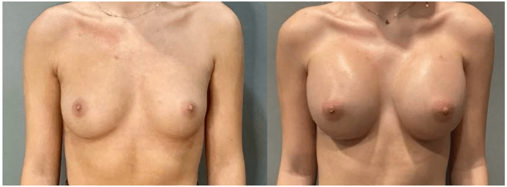 Before and After Image: Breast Augmentation - front