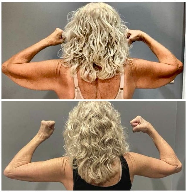 Before and After Image: 73 year old with recent brachioplasty - back