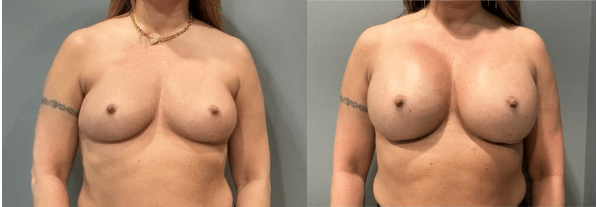 Before and After Image: Breast Augmentation - front
