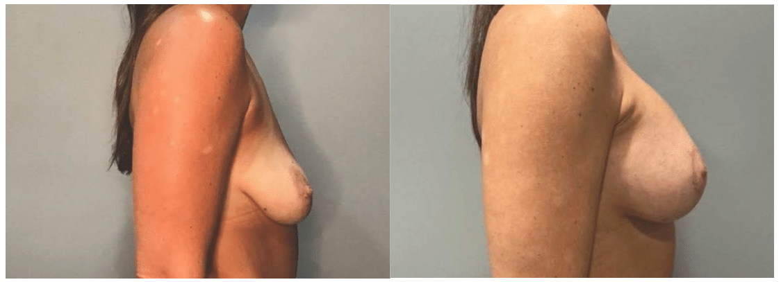 Before and After Image: Mastopexy augmentation - right-side