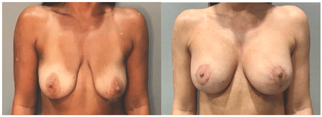 Before and After Image: Mastopexy augmentation - front