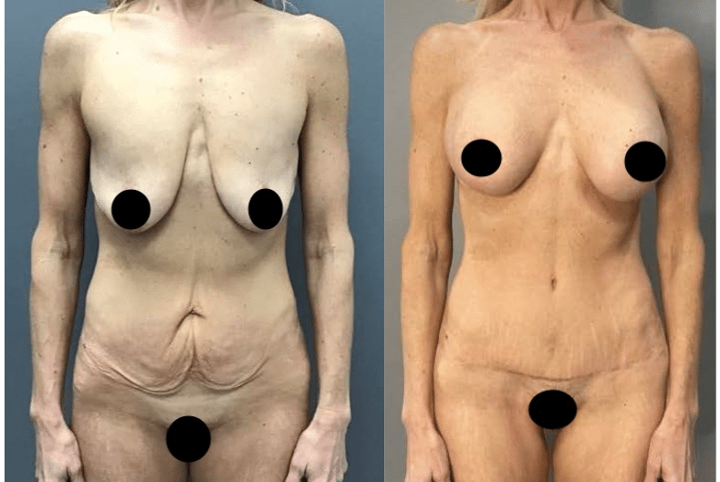 Before and After Image: Breast Body Mommy Make Over - front