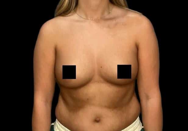 Before Image: Breast Augmentation - front