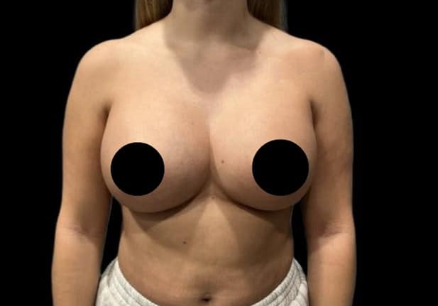 After Image: Breast Augmentation - front