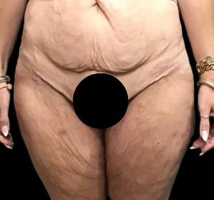 Before Image: Circumferential Body Lift - front