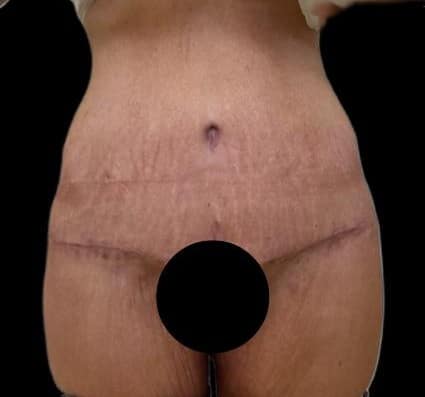 After Image: Circumferential Body Lift - front