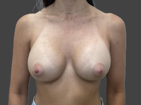 After Image: Breast Augmentation- Moderate Plus Saline Breast Implants 400cc - front