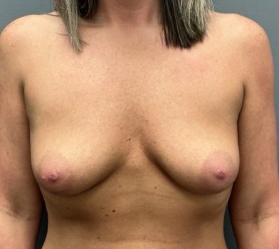 Before Image: Breast Augmentation - front