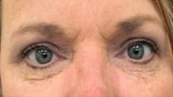 After Image: Upper Blepharoplasty - front