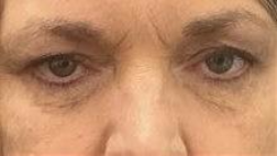 Before Image: Upper Blepharoplasty - front