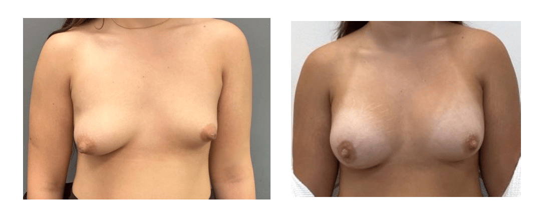 Before and After Image: Breast Augmentation - front
