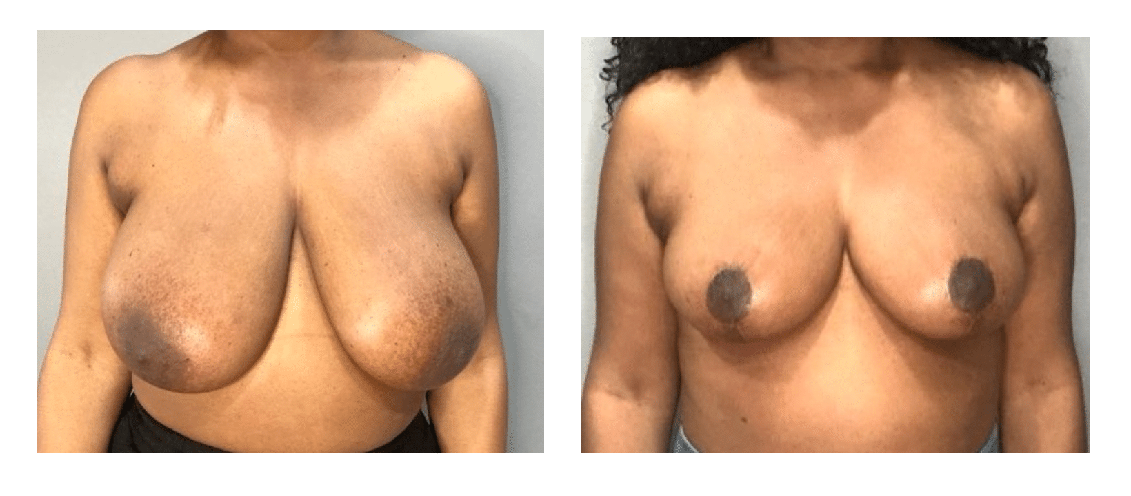 Before and After Image: Breast Reduction - front
