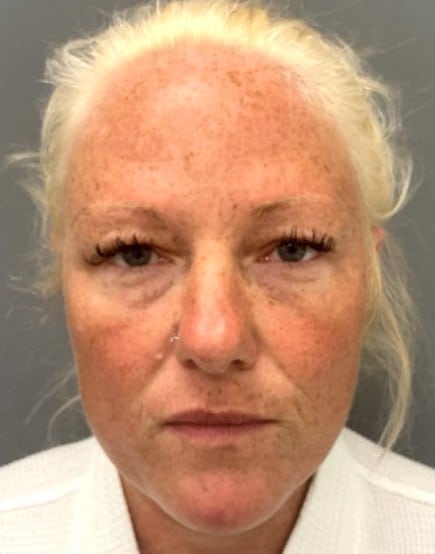 Before Image: Blepharoplasty - front