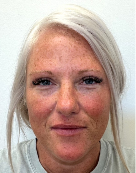 After Image: Blepharoplasty - front
